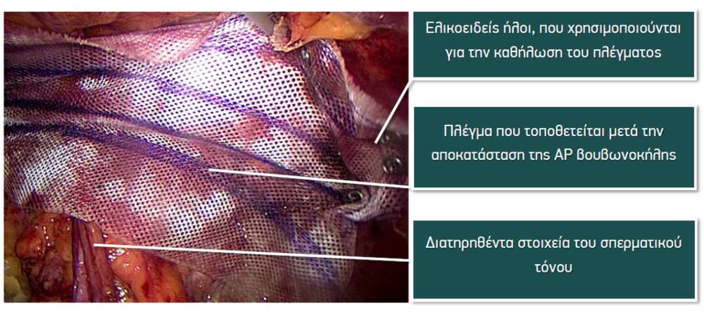 Λαπαροσκοπική αποκατάσταση βουβωνοκήλης TEP