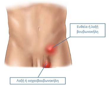 Βουβωνοκήλη - Inguinal Hernia