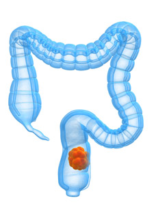 Παθήσεις παχέος εντέρου - Colorectal diseases