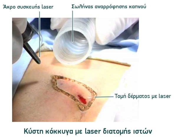 Κλασσικό laser κύστη κόκκυγα