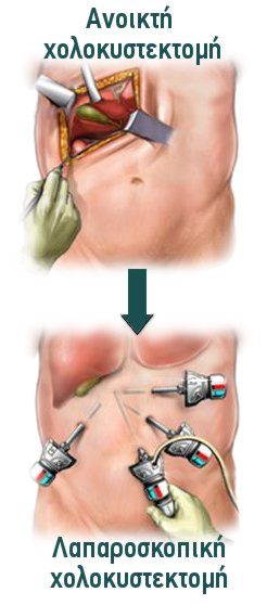 Λαπαροσκοπική vs Ανοικτή Χολοκυστεκτομή