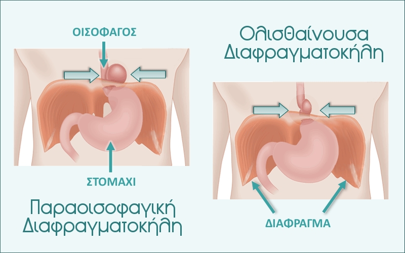 Διαφραγματοκήλη